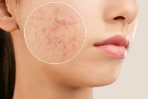 acne traitement de la peau